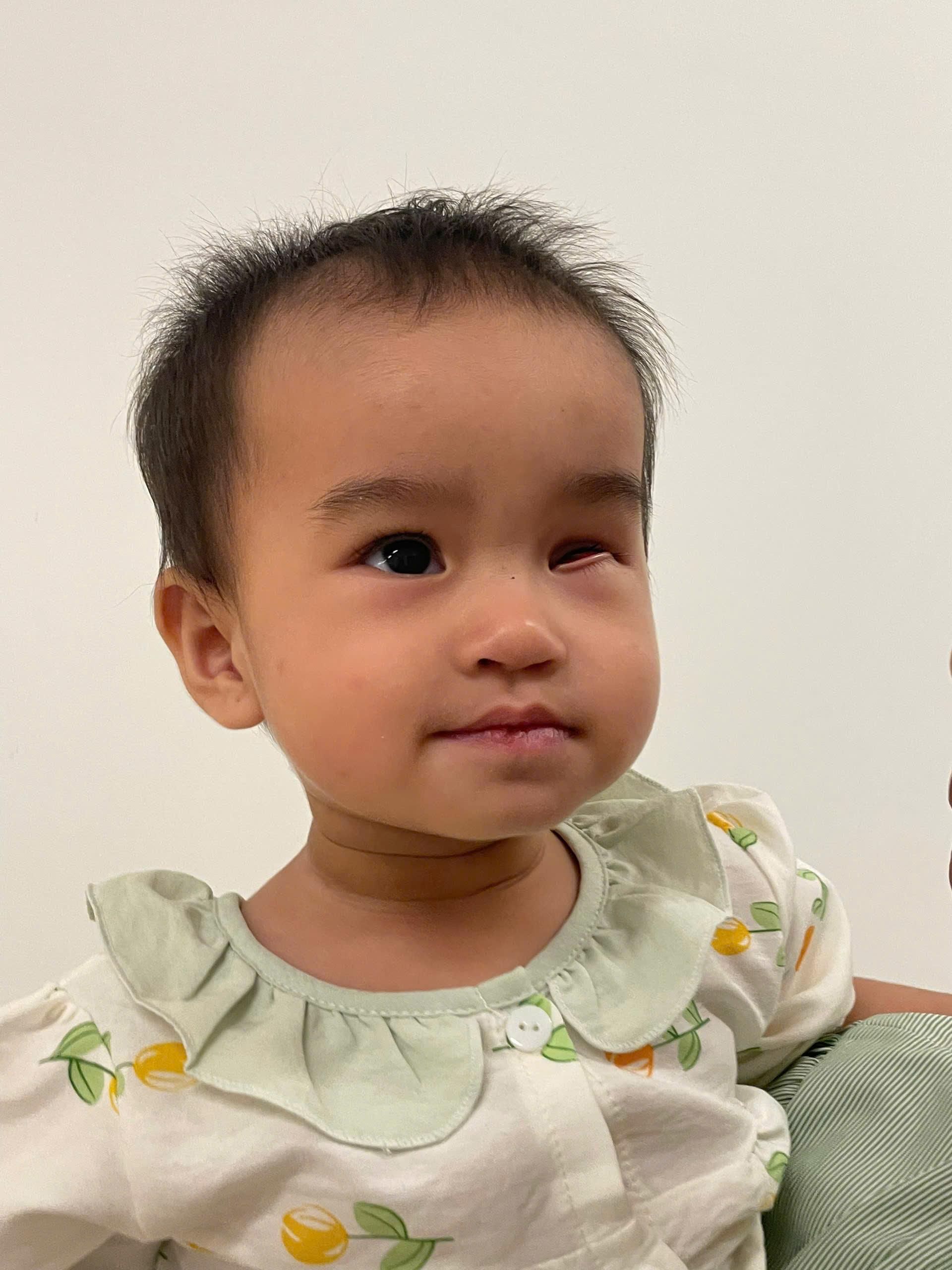 Lê Huỳnh Bảo Yến điều trị u nguyên bào võng mạc